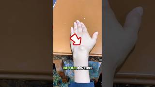 Weird Bump On Your Hand?