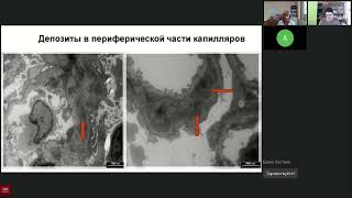 видео: Болезнь Берже картинка: Болезнь Берже