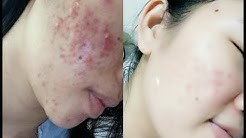 Cara Menghilangkan jerawat dan bekas jerawat Menahun secara ALAMI!! - Durasi: 6.28. 