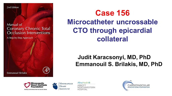 Case 156: Manual of CTO PCI - Epicardial tip in
