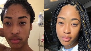 HOW TO GET RID OF ACNE + DARK SPOTS (APPLE CIDER VINEGAR)