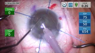 Axenfeld-Rieger Syndrome, Cataract, Microcornea, Iris Hooks, Zonulopathy, Toric IOL