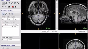 Registering stroke lesions to template space using LESYMAP