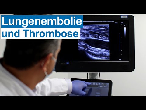 Thrombose und Lungenembolie: