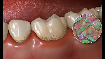 ¿Qué causa la placa en los dientes?