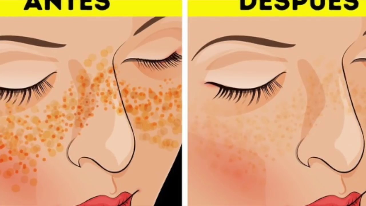 medicina natural para la gastritis 7 DÍAS USANDO VINAGRE DE MANZANA EN EL ROSTRO! / Medicina Natural Para Todos