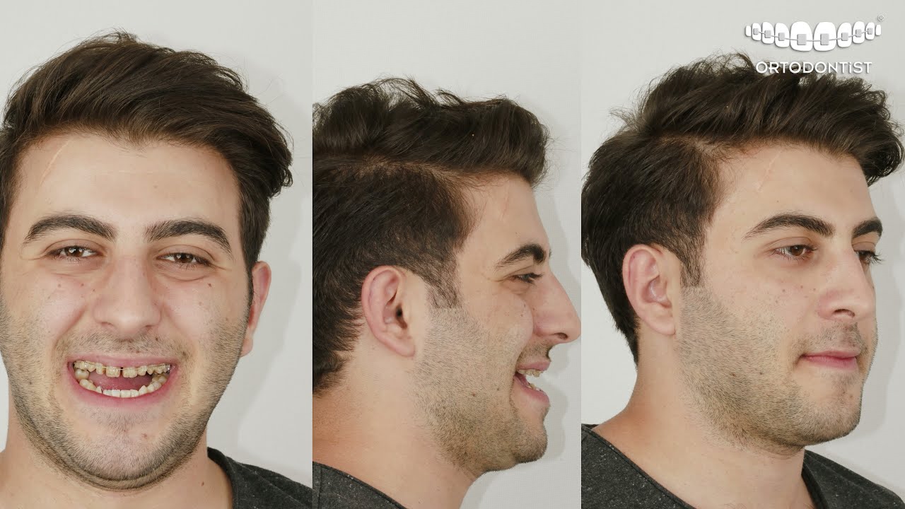 Osman Bey çift çene ameliyatı / Orthognathic surgery of Mr.Osman (before and 10 days after )