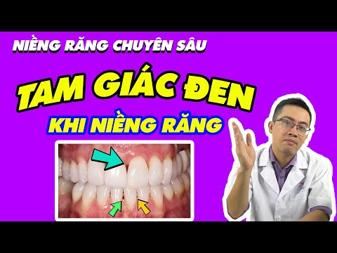Video TAM GIÁC ĐEN KHI NIỀNG RĂNG? NGUYÊN NHÂN VÀ PHƯƠNG ÁN... - youtube