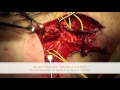 Surgery for brachial plexus injury - Contralateral C7 ...