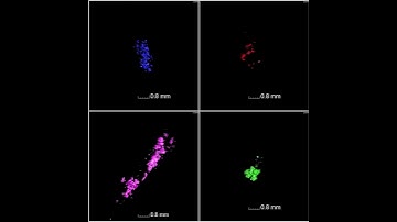 Micro-CT rendering of breast microcalcification