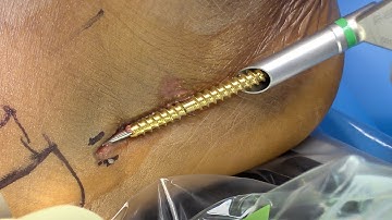 5th Metatarsal (Jone