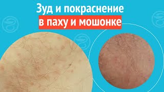 😦 Зуд и покраснение в паху и мошонке. Клинический случай №1356