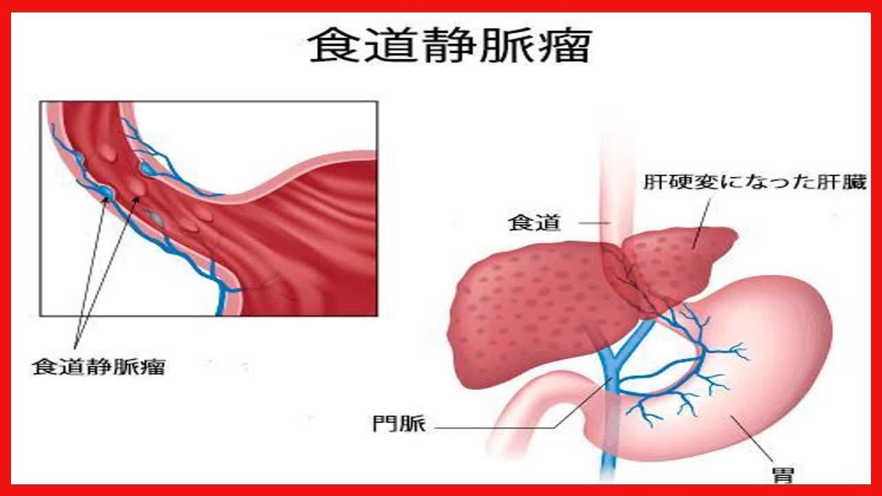 誰が静脈瘤の非侵襲的治療を受ける必要がありますか?