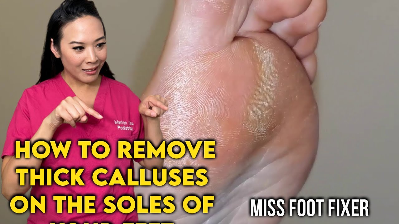 How to Remove Thick Calluses on the Soles of Your Feet By Famous