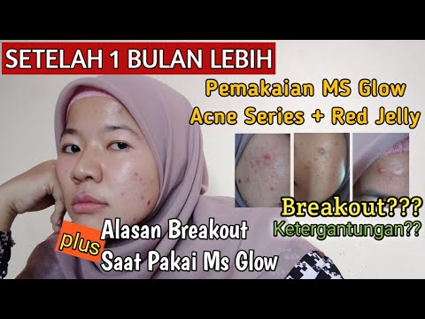 REVIEW 1 BULAN PEMAKAIAN MS GLOW ACNE SERIES DAN RED JELLY