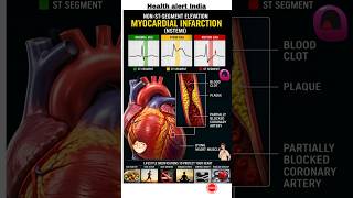 🚨 NSTEMI Heart Attack Warning Signs | ECG Me Ye Dikhe To Alert Ho Jao#heart #headshot