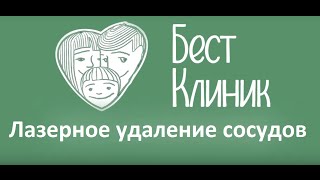 Лазерное удаление сосудов. Лазерное удаление сосудов в Бест Клиник.(, 2016-03-31T08:00:17.000Z)