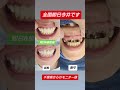 全国即日今井です。本日5月21日は千葉県からのモニター様がカウンセリング後、即日セラミックスタートしました。金属入り差し歯、セラミックのやり直しを含む8歯を即日仮歯まで進めていきました #セラミック
