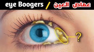 ماهو عماص العين؟! وكيف يصنع _ eye Boogers medical animation