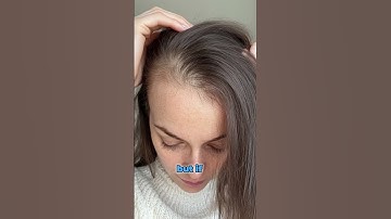 FEMALE HAIR LOSS | GENETICS AND DHT EXPLAINED | TOP SCALP
