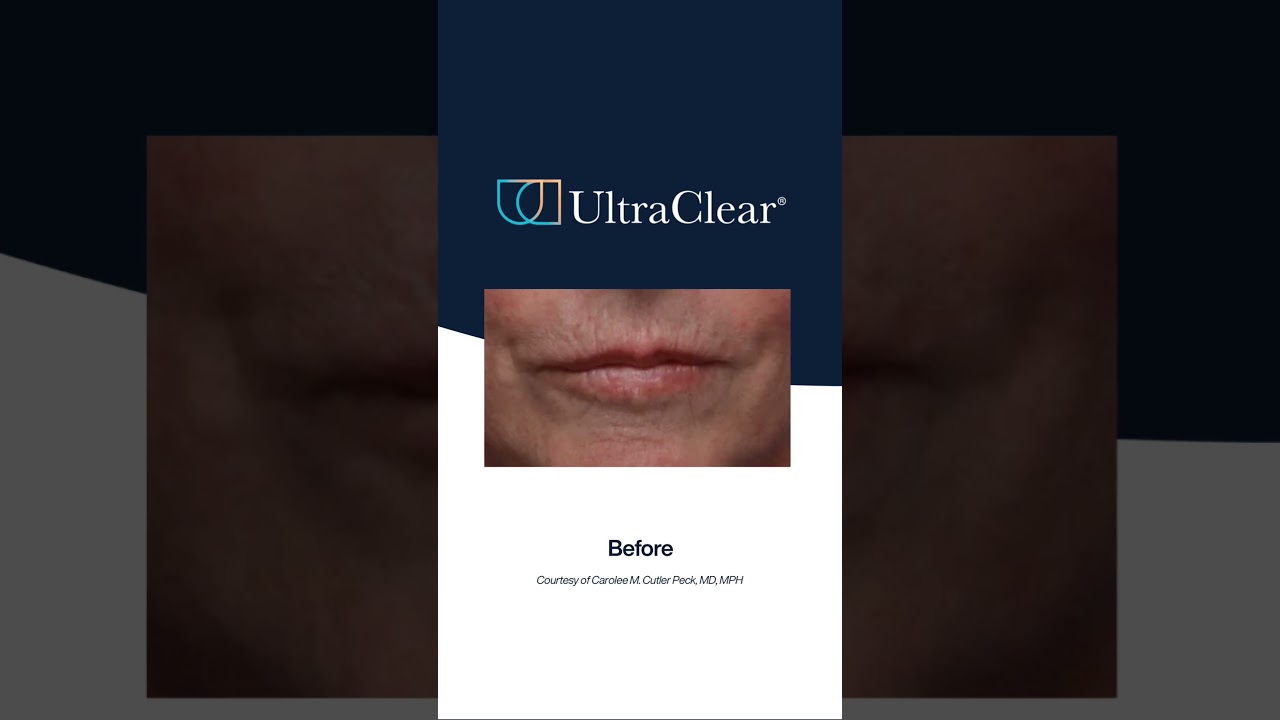 Elevating perioral rejuvenation with Laser-Coring™.