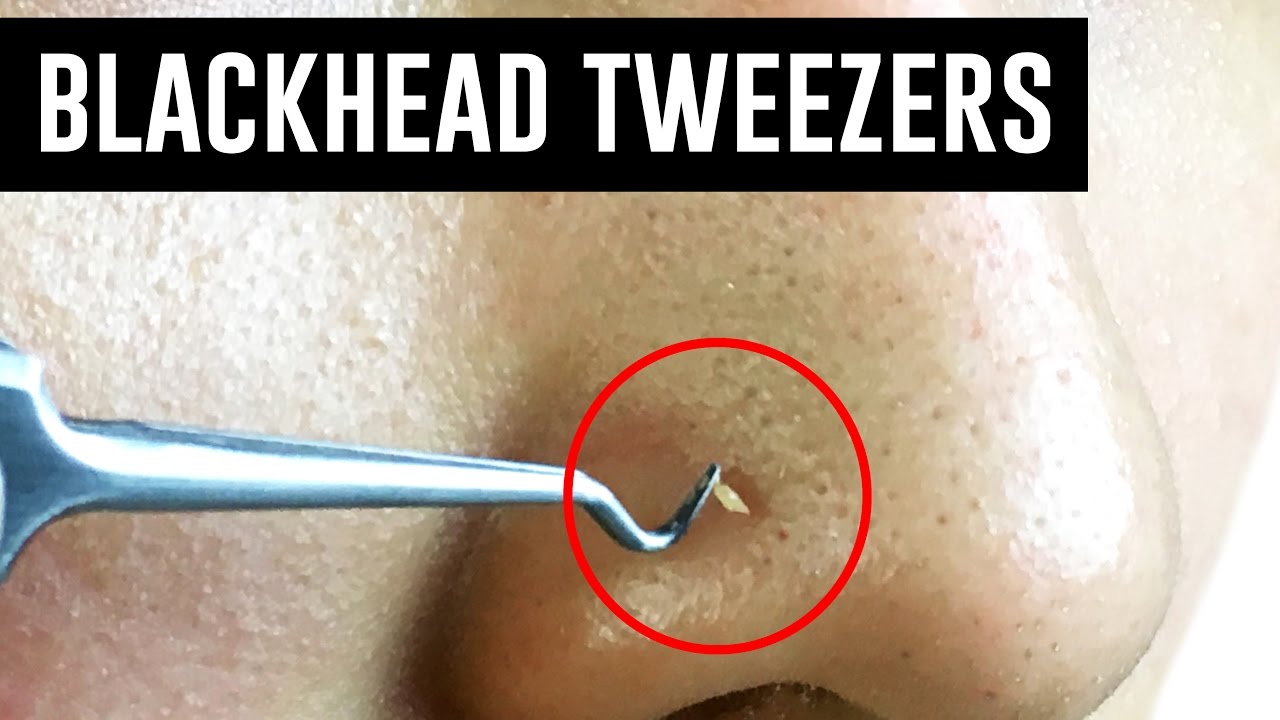 blackhead removal