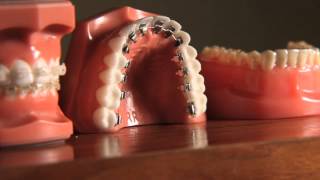 Braces Are Far More Attractive Than Crooked Teeth