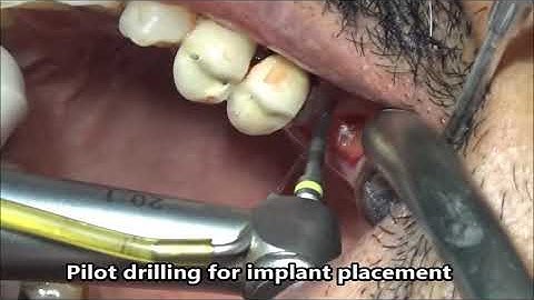 First upper molar extraction & immediate KOS implants