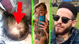 HIDING HAIR LOSS FOR 5 YEARS - *How I BEAT BALDING - Baldcafe Podcast 25