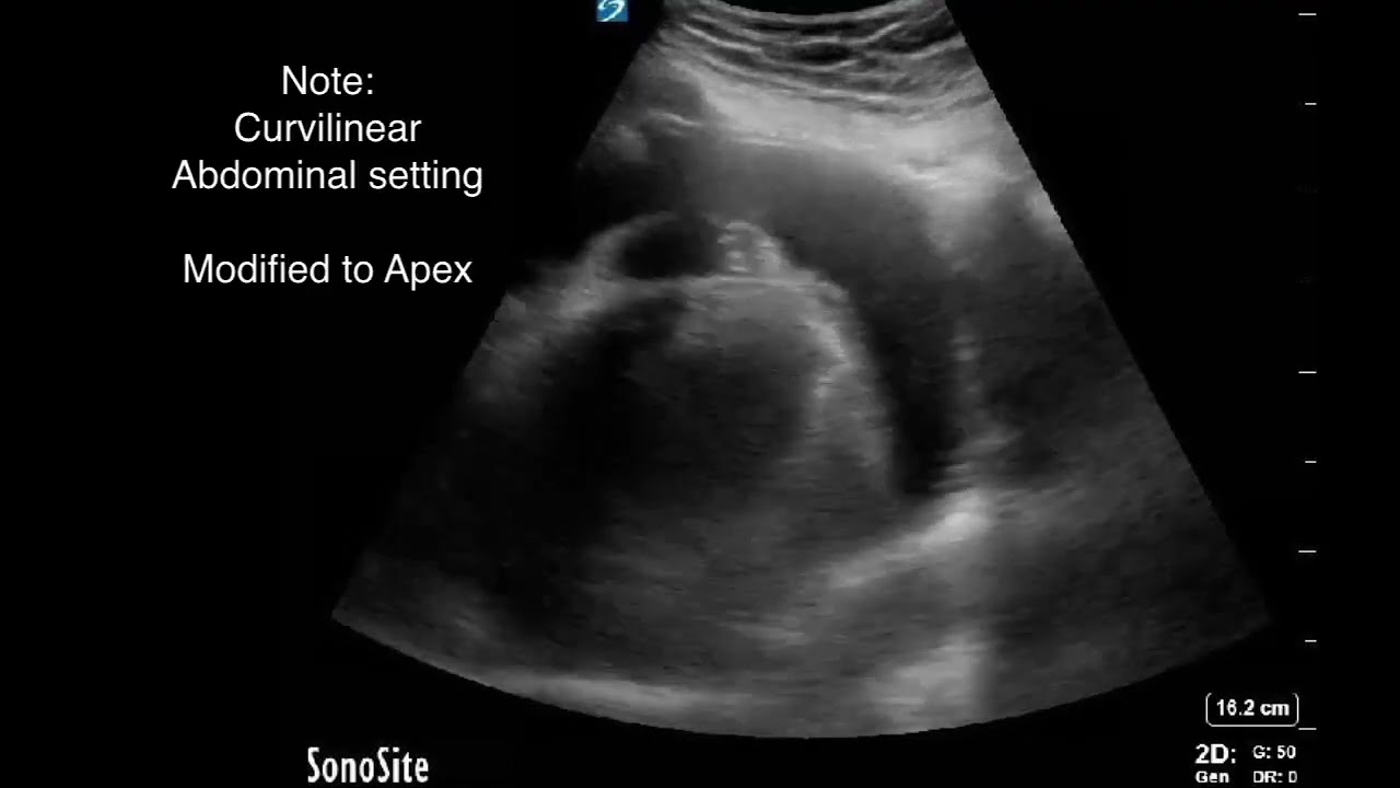 #POCUS guided Pericardiocentesis; An Intuitive Approach