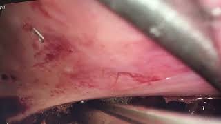 Laproscopic Low Anterior resection 