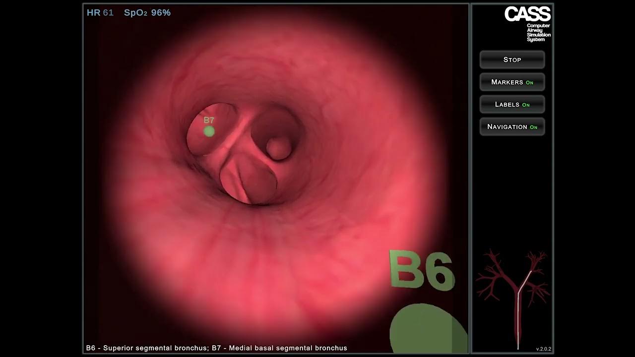 CASS Virtual Reality Bronchoscopy Simulator normal anatomy 1 YouTube
