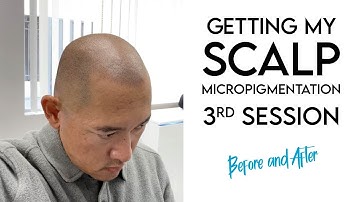 Getting My Scalp Micropigmentation (SMP) | 3rd Session