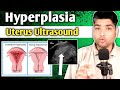 Hyperplasia in Uterus Ultrasound by Dr Ali Waqar