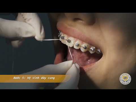 Video: 4 cách dùng chỉ nha khoa khi niềng răng