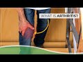 What is Arthritis? | Dr. Vijay Kumar Sohanlal