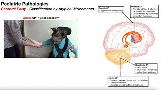 Cerebral Palsy Overview 🧠 Introduction &amp; Classifications