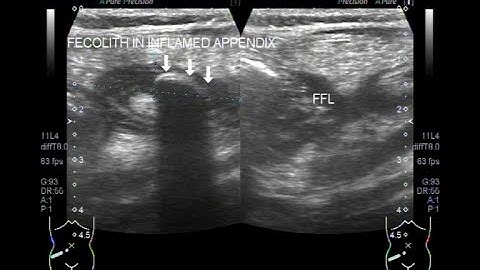 Ultrasound Video showing Fecolith in Appendix.