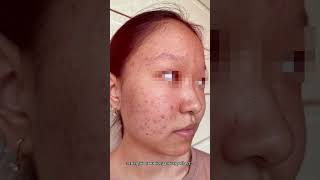 #акнекутан #какизбавитьсяотакне#акнелечение #доипосле#алматы