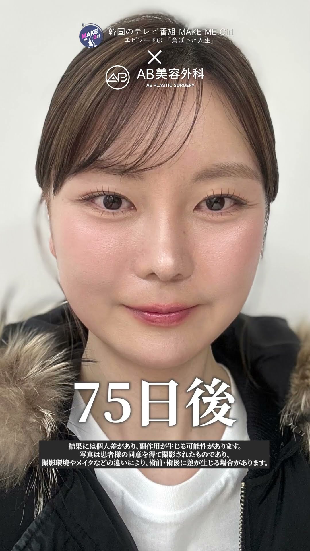 美容整形75日後… 驚きのビフォーアフター！ #韓国整形 #美容