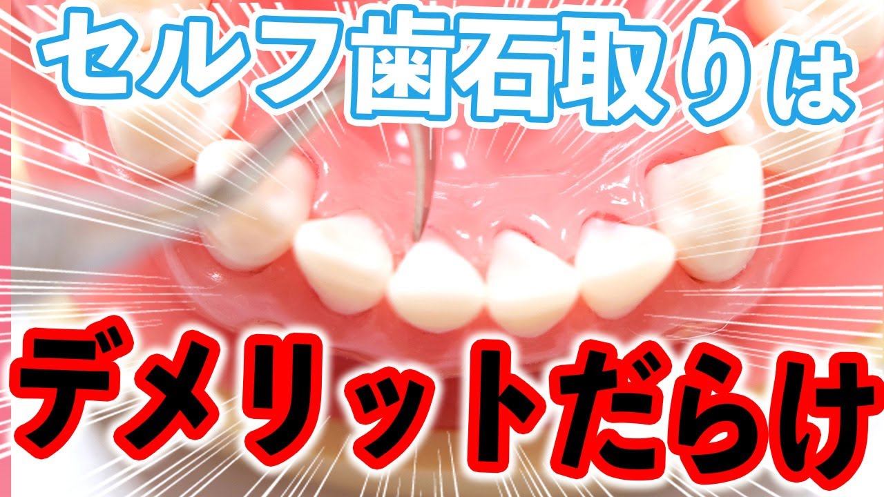 ダイソーで買える歯石とりアイテムは歯を にしてしまう Shorts Youtube