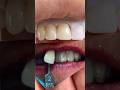 Layered Zirconia crown that we just completed in my lab for Dr. Chris Davenport in Virginia