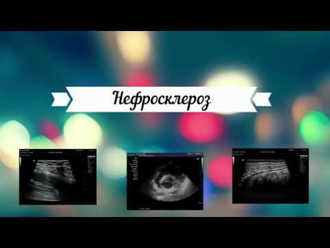 Нефросклероз
