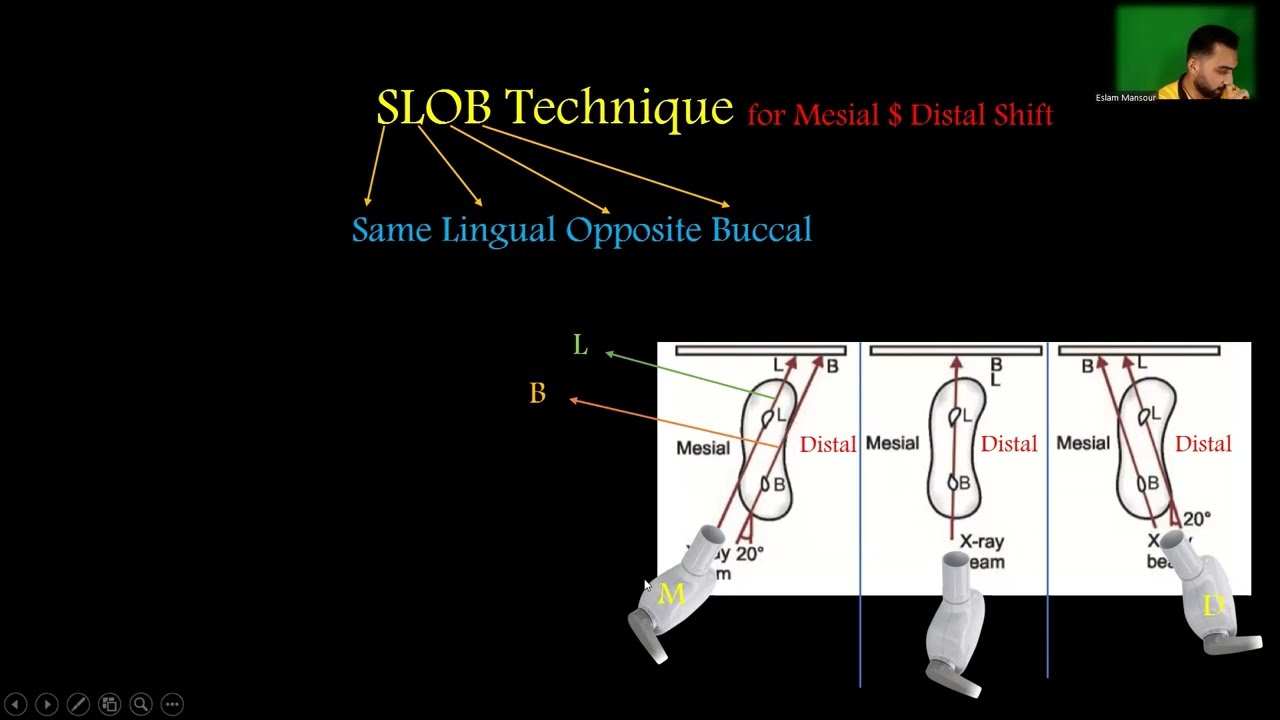 ازاي تاخد X-Ray ب Mesial او Distal-Shift# -يعني ايه SLOB-Technique#
