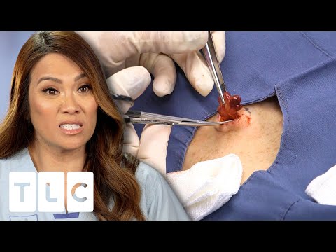 "It Doesn't Look Like A Cyst, It Doesn't Look Like A Lipoma. What Is It?" | Dr Pimple Popper Pop Ups