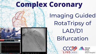 Imaging Guided RotaTripsy of LAD/D1 Bifurcation