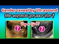 Gender reveal by ultrasound