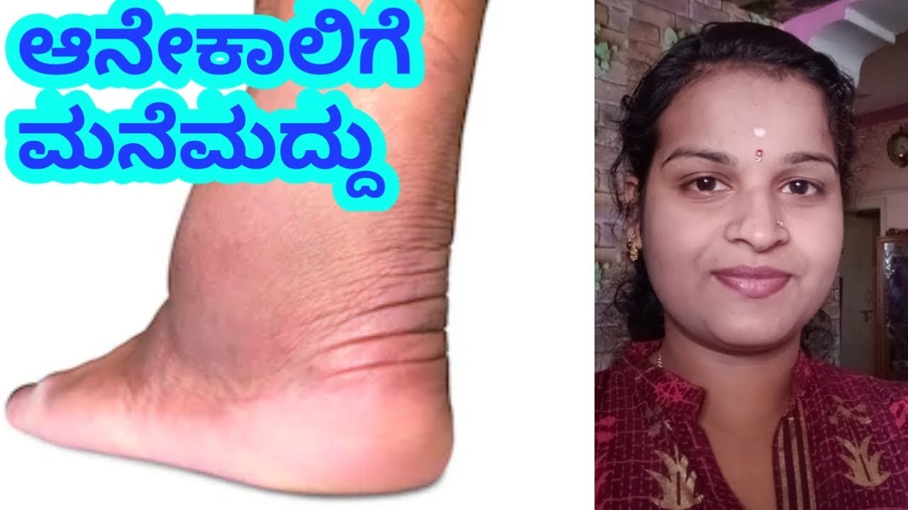 ಆನೇಕಾಲು ರೋಗಕ್ಕೆ ಮನೆಮದ್ದು l how to control leg swelling problems l