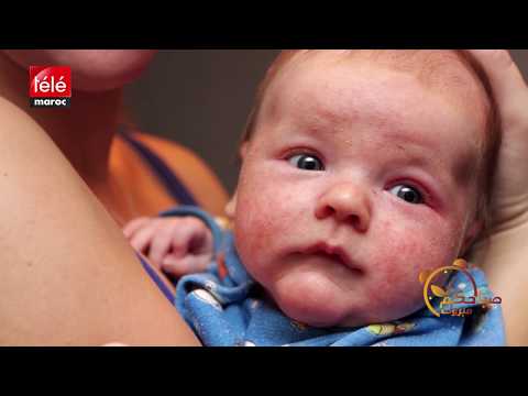 تعرفوا على مسببات حساسية الجلد اكزيما