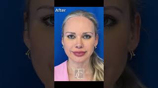 Facial rejuvenation through endoscopic brow lift and mid-face lift.  #beforeandafte